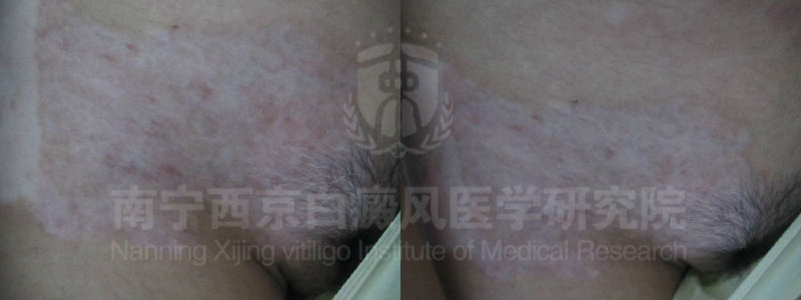 青少年右髋部白斑半年余康复案例 图片3、4.jpg
