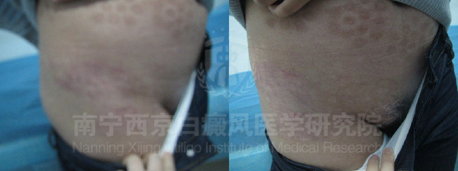 青少年右髋部白斑半年余康复案例 图片5、6.jpg