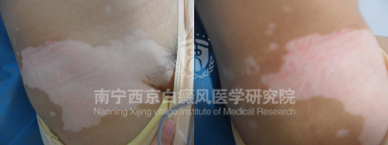 青少年右髋部白斑半年余康复案例 图片1、2.jpg